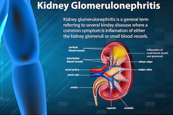 Glomerulonephritis